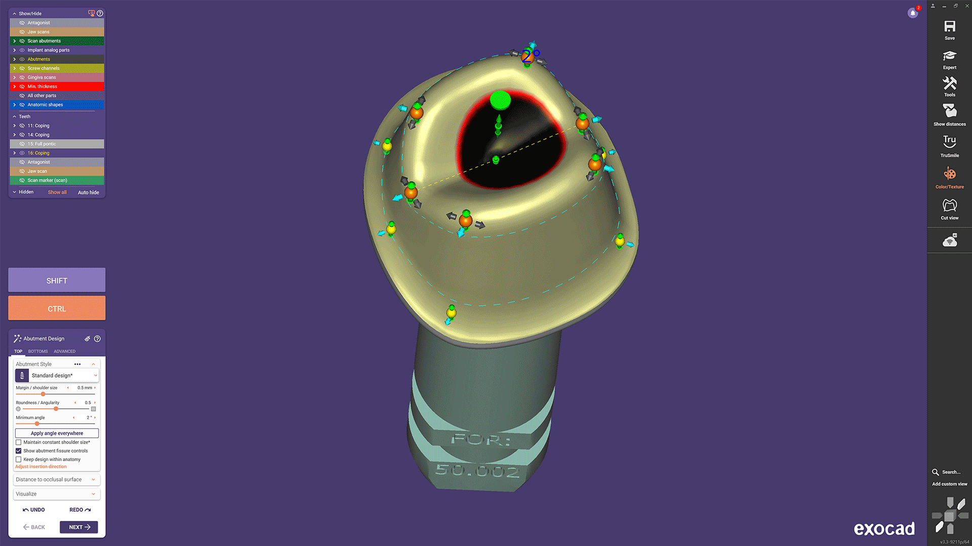 DentalCAD Implant Module proposal