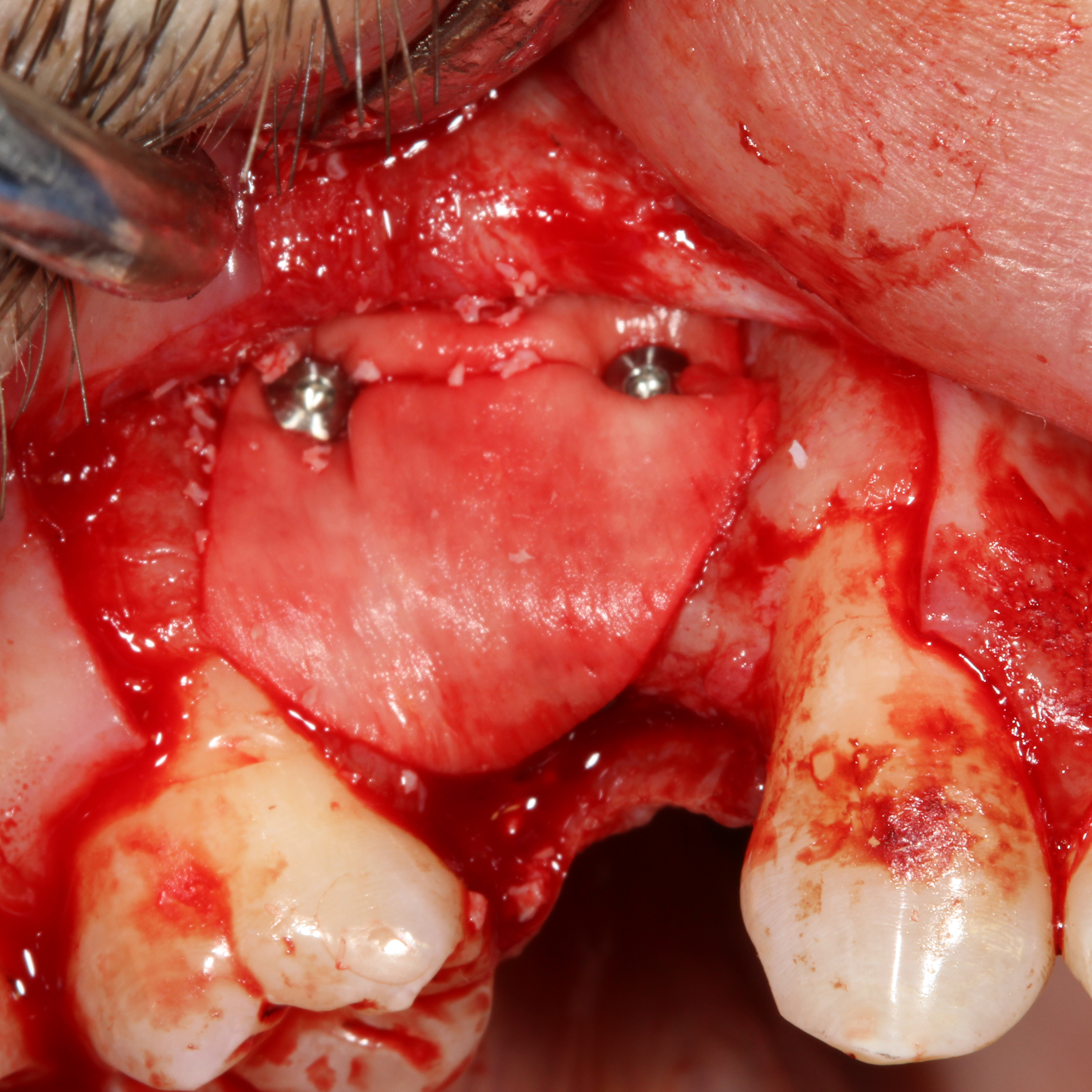 Implant Placement And Simultaneous Guided Bone Regeneration in Congenitally Missing Premolar: Case Report