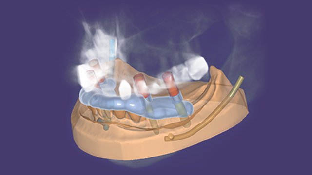 Implant Planning & Guide Design